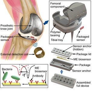 Illustration showing device concept diagram of wireless biosensor for early detection of periprosthetic joint infection (PJI) in newly implanted knee joint prosthetics