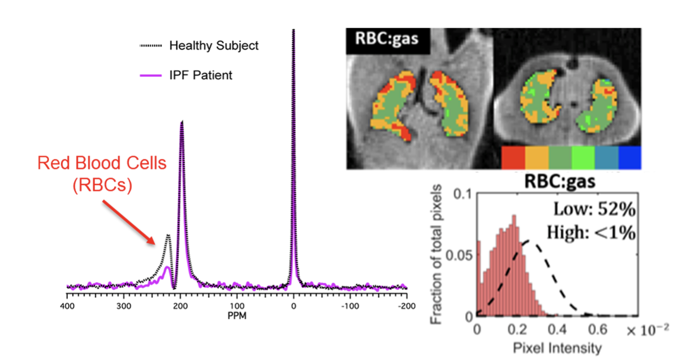Graph showing red blood cells increase; lung mri